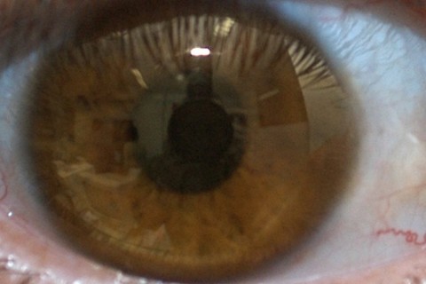 Fundação Ezequiel Dias irá produzir medicamento para degeneração macular