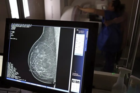 Plano de saúde terá que cobrir mamografia digital para todas as idades
